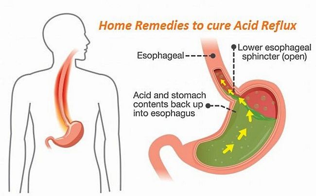 Home remedies can be very effective for many people
