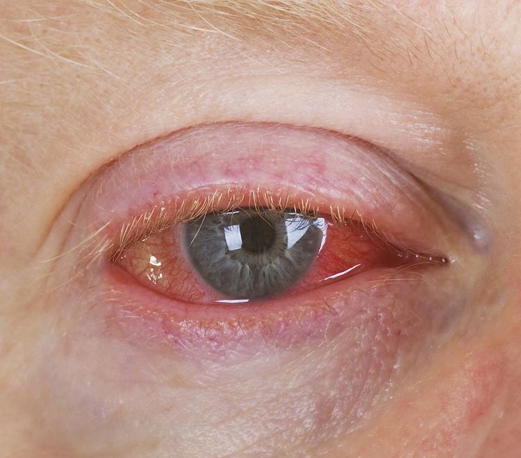 Excessive redness is a sign of severe inflammation and it is time to see your doctor