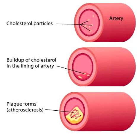 Plague build up in arteries caused by cholesterol