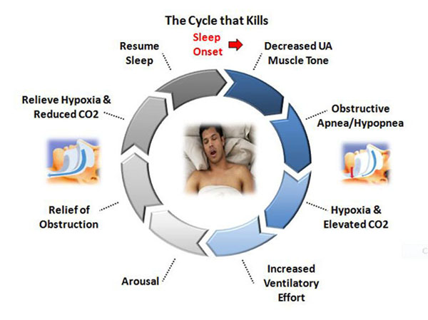 The sleep apnea cycle