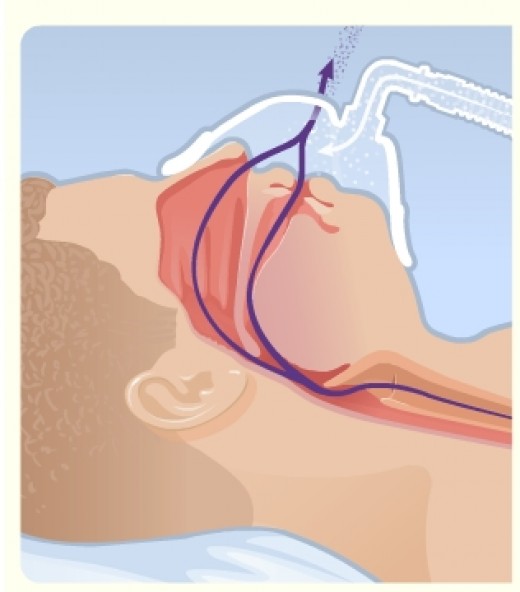 Airway remains open when patient exhales as the positive pressure is maintained.