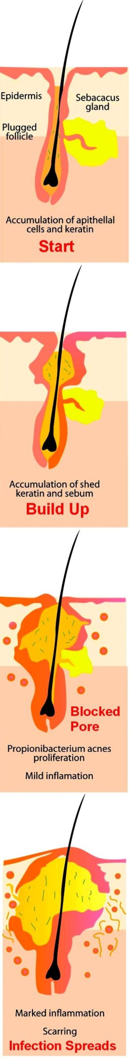 Stages in the development of acne