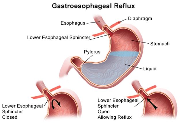 How acid reflux causes problems after eating some foods