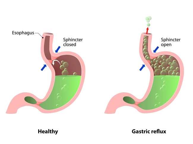 What is acid reflux?