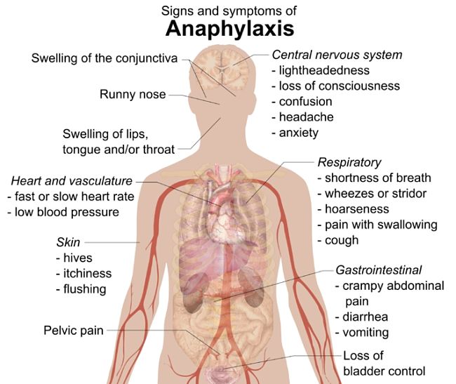 Signs and symptoms of Anaphylaxis