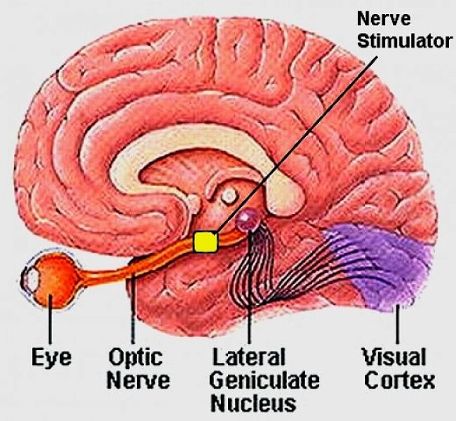The Direct Stimulation of the optic nerve approach for developing the bionic eye