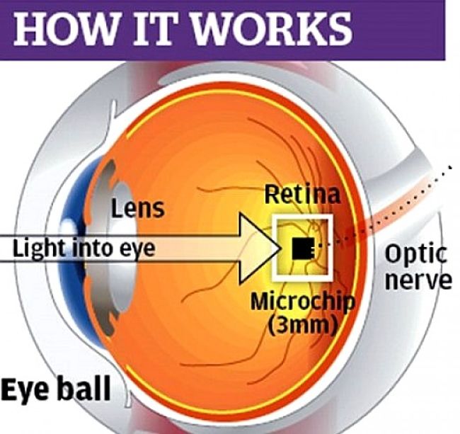 The Subretinal Implant approach depends on an intact eyeball being available