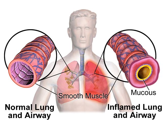 Many children show less severe symptoms of Asthma and less frequently. See why here