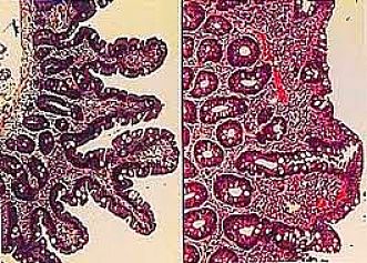 Villi area greatly reduced by Coeliac Disease