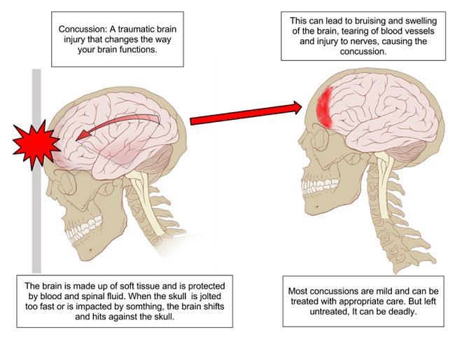 Concussion damages the drain and cause impaired brain function and loss of consciousness