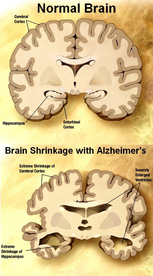 Alzheimer's Disease causes brain shrinkage and loss of memory