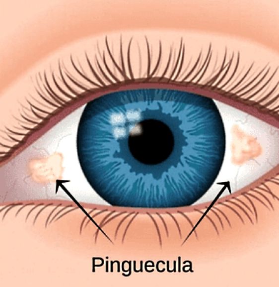 Example of a Pinguecula on the white part of the eye.