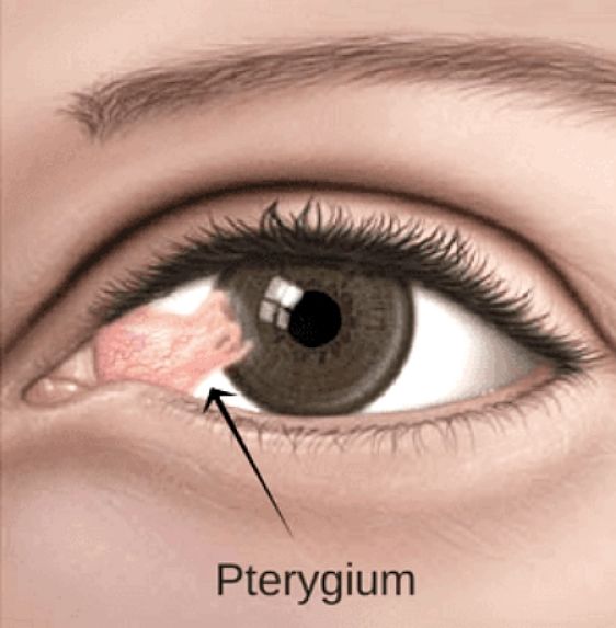 Example of a Pterygium on the white part of the eye