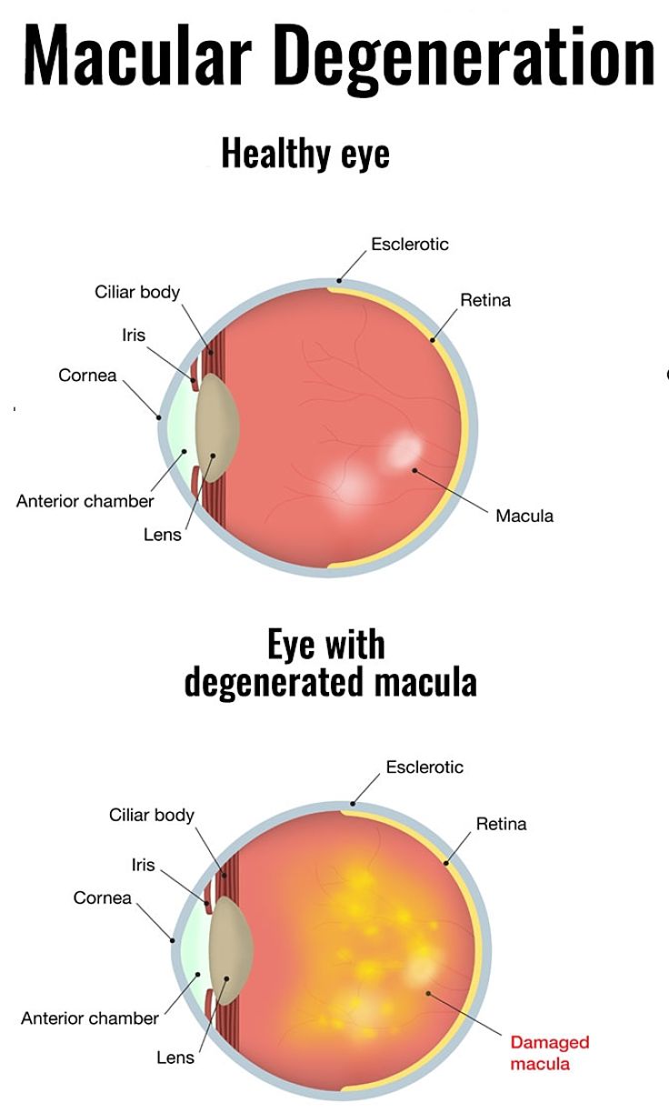 Description of Macular Degeneration