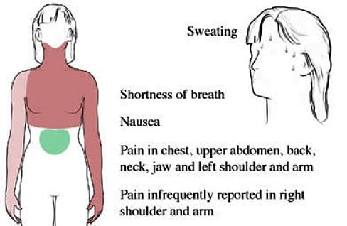 General Heart Attack Symptoms in Women