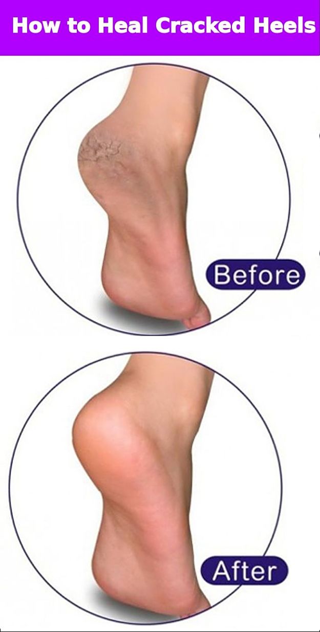 Simple advice for treating cracked heels