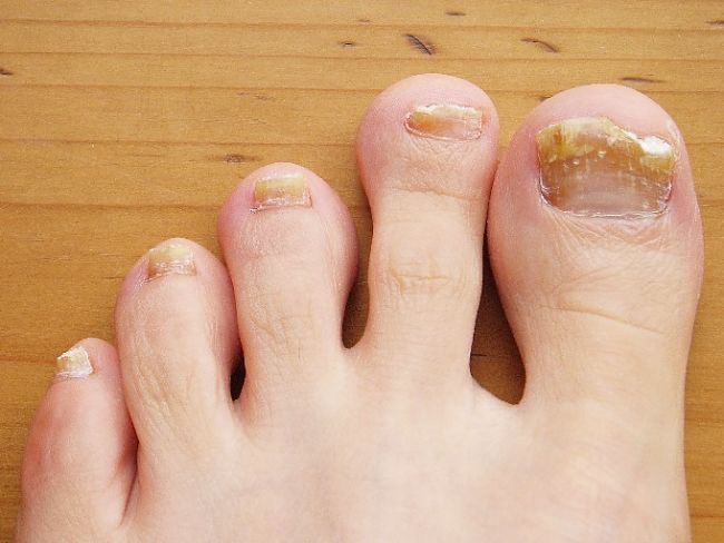 Nail fungus causes brittle and unsightly nails and is very hard to cure