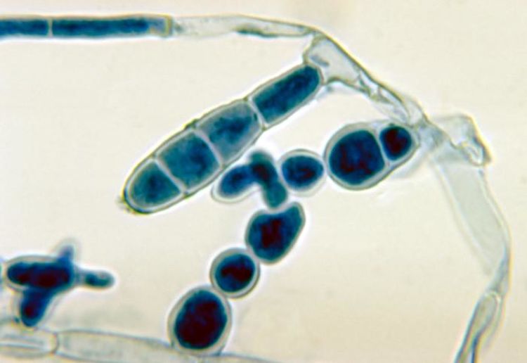 The fungus Onychomycosis causes a range of Tinea type of infections including nail fungus