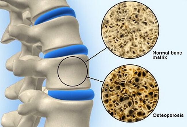 Lose of bone density in the spine