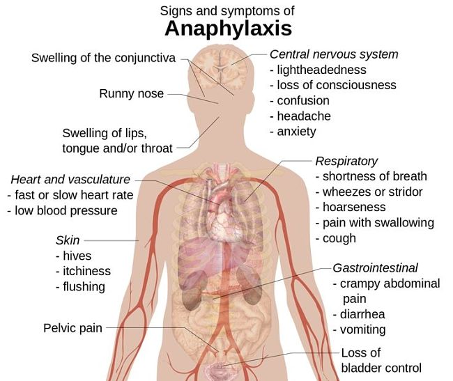 Symptoms of Anaphylaxis you should be aware of