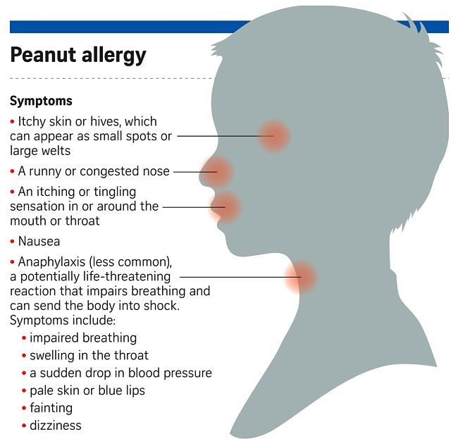 Symptoms to look for as signs of peanut allergies