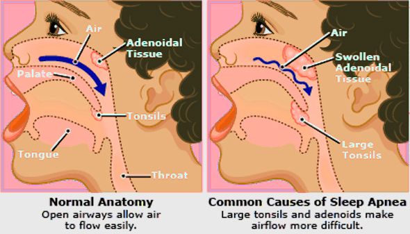 Sleep apnea can occur in children from a variety of causes