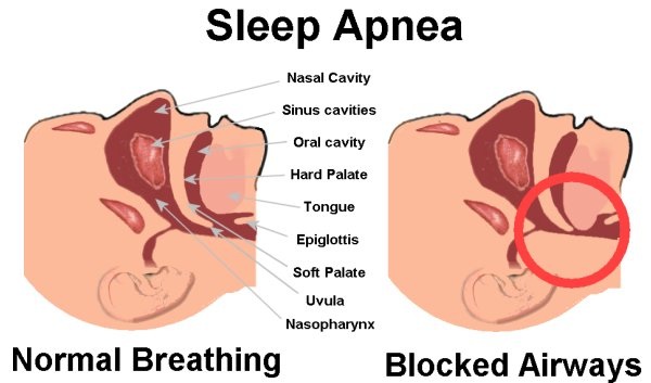 What is sleep apnea