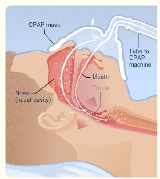 Positive Pressure Reopens the Blocked Airways